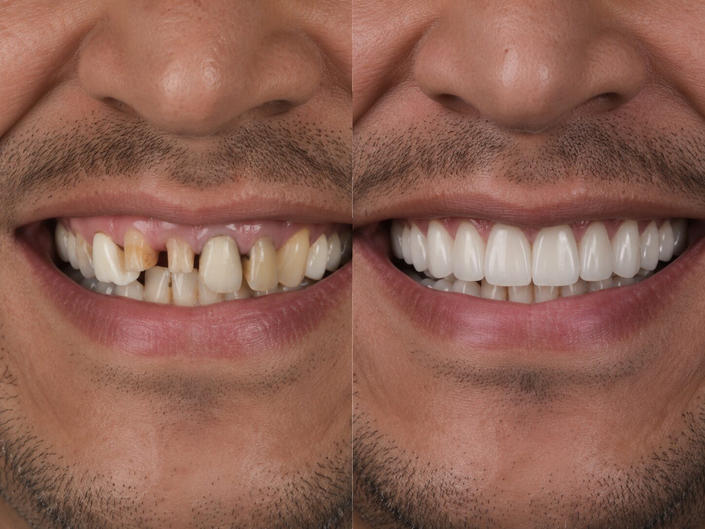 DentaLaser
