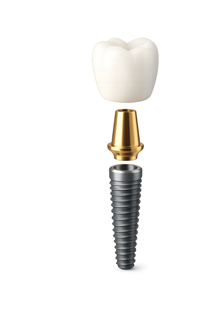 Implante, pilar y corona — Dental Rivas