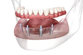 All-on-4 — arcada fija sobre cuatro implantes