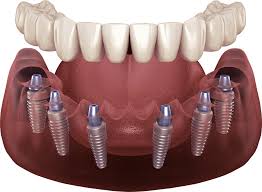 All-on-6 — arcada fija sobre seis implantes