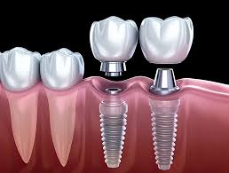 Implante dental — raíz de titanio con corona