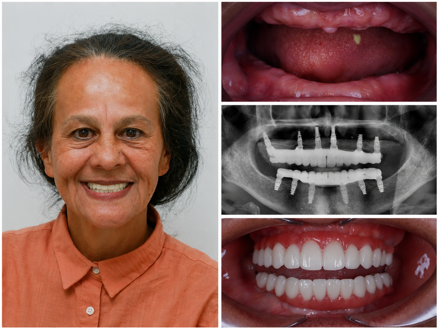 Prótesis — Dentalplus
