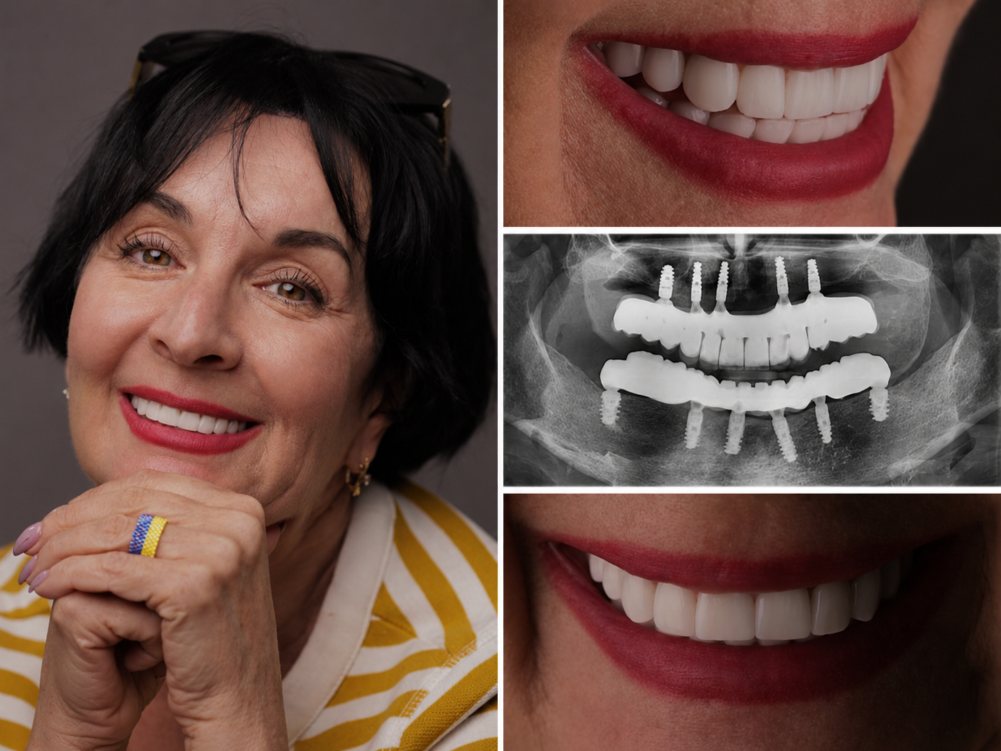 Rehabilitación de arcada completa — Dentalplus