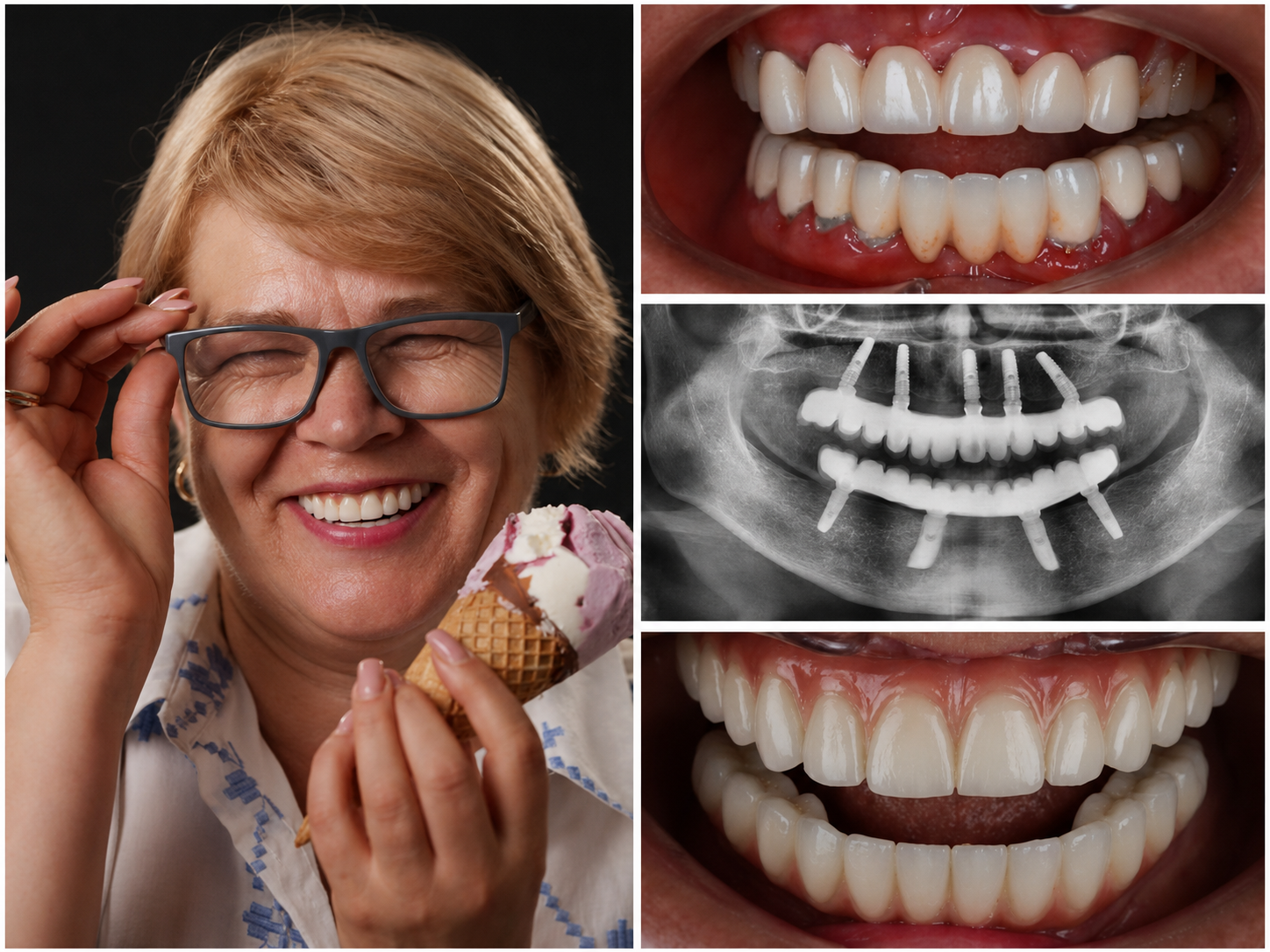 Radiografía de implante — Dentalplus