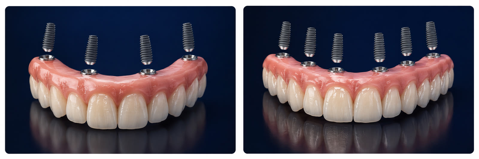 Tecnología de implantes — Dentalplus