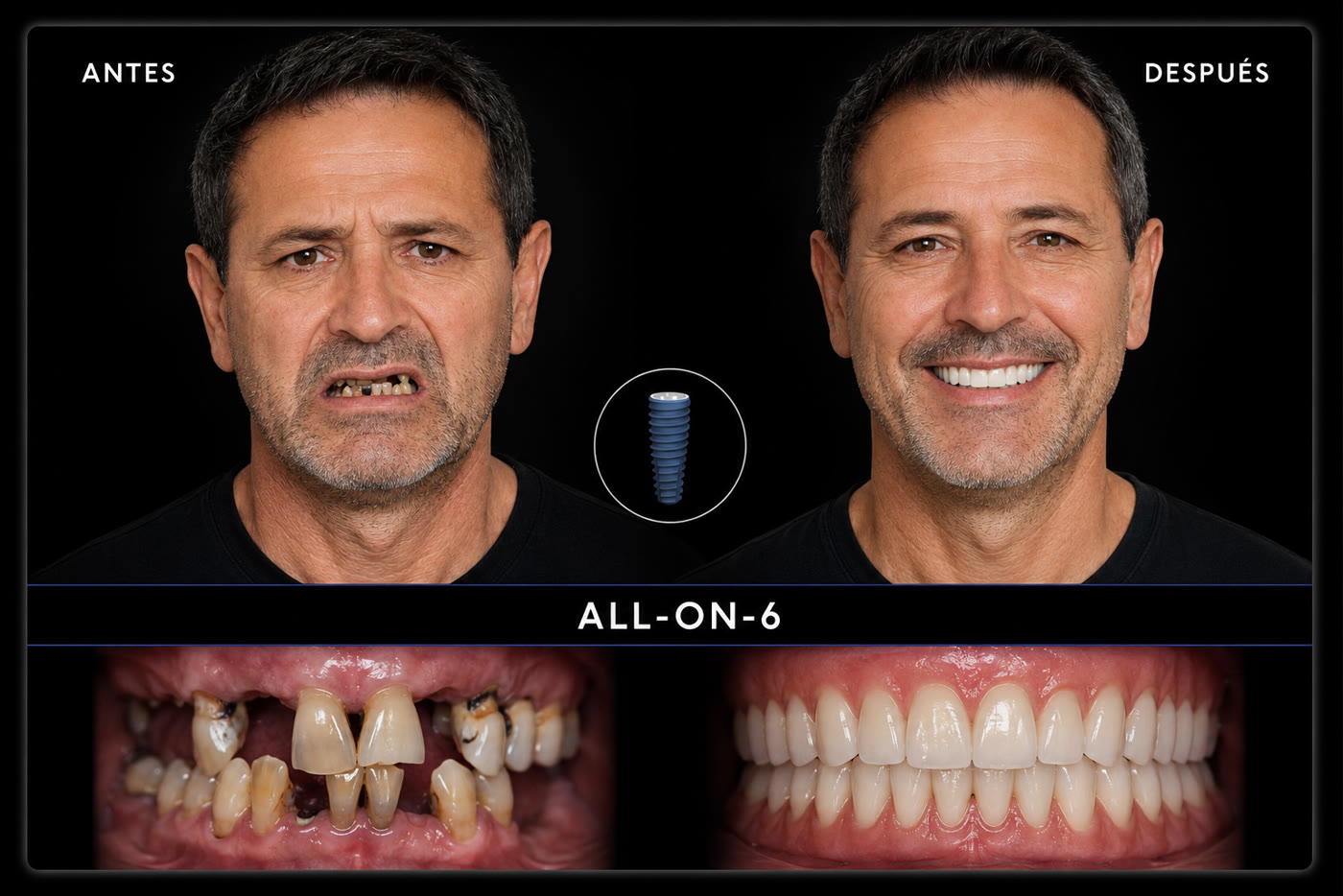 Antes y después — dientes fijos sobre 6 implantes